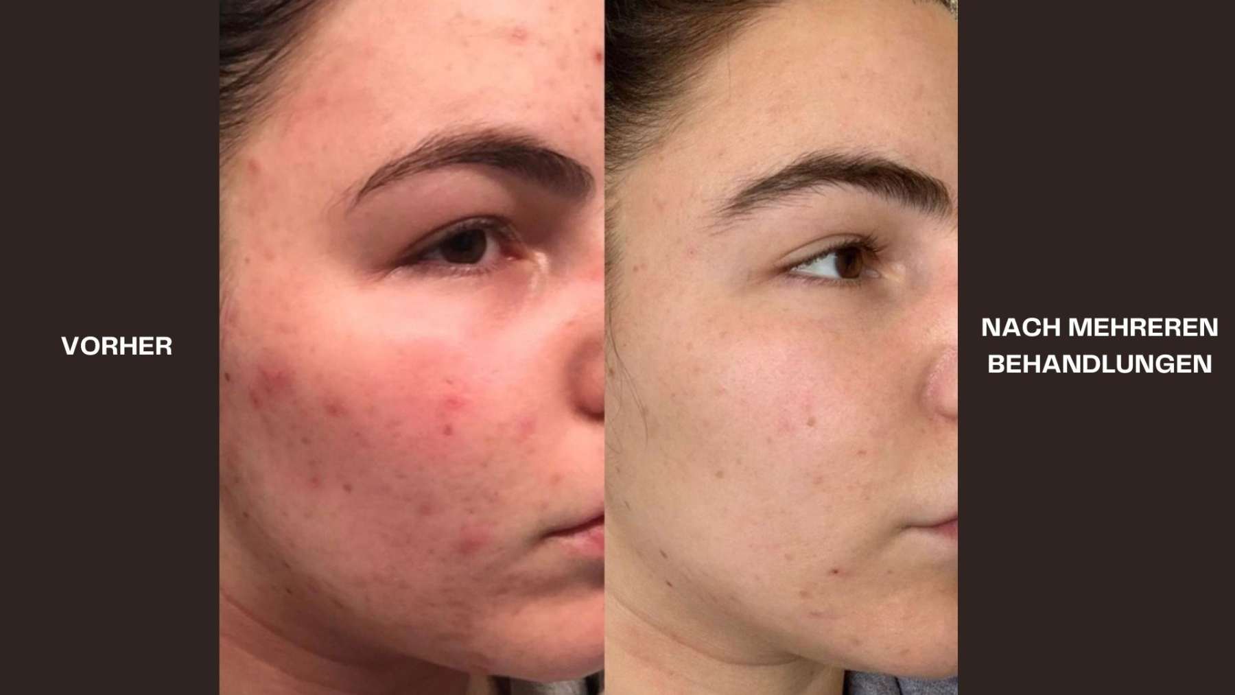 Hydrafacial Vorher - Nacher Bild Akne (3)