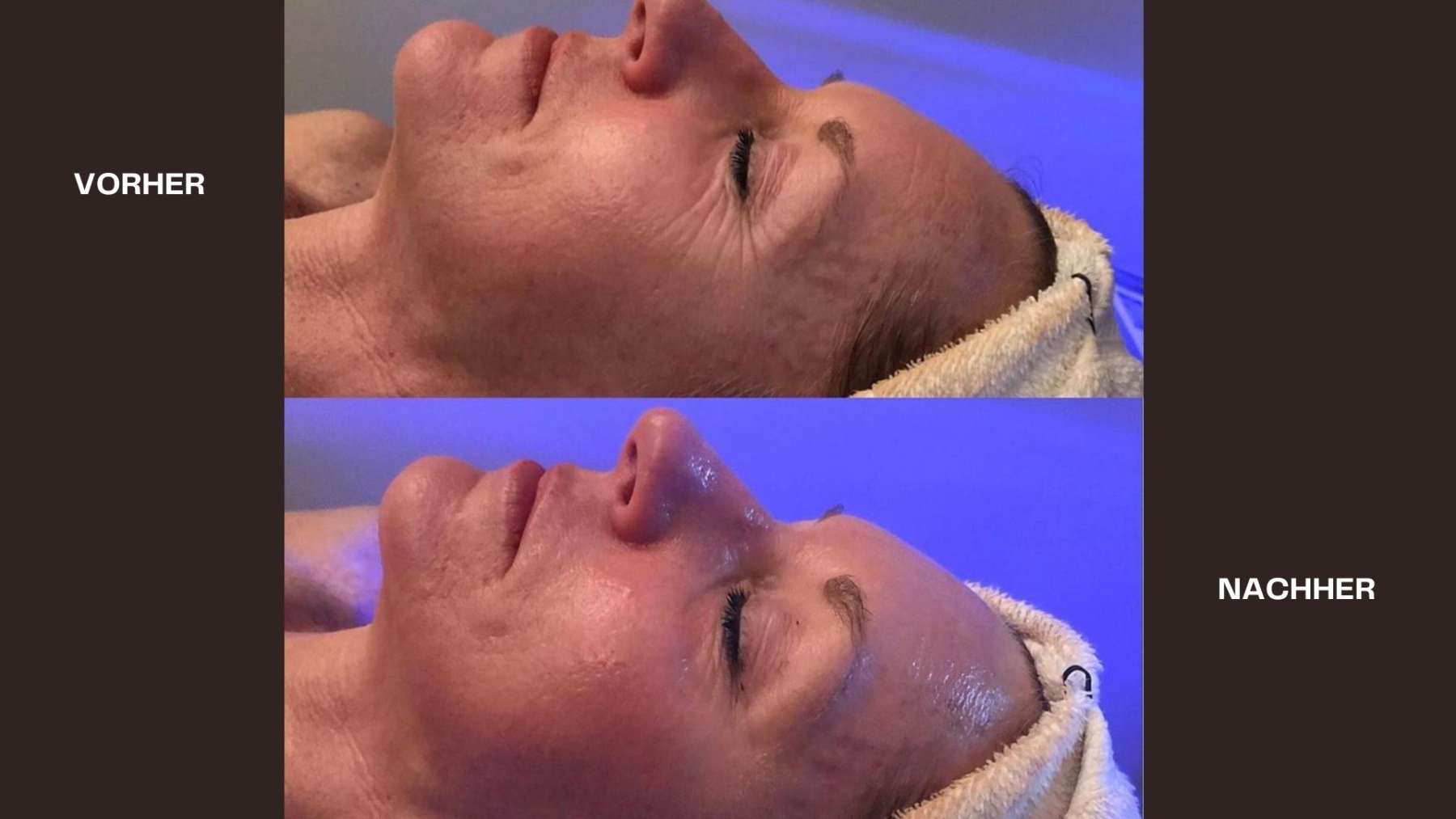 Hydrafacial Vorher - Nacher Bild Glow