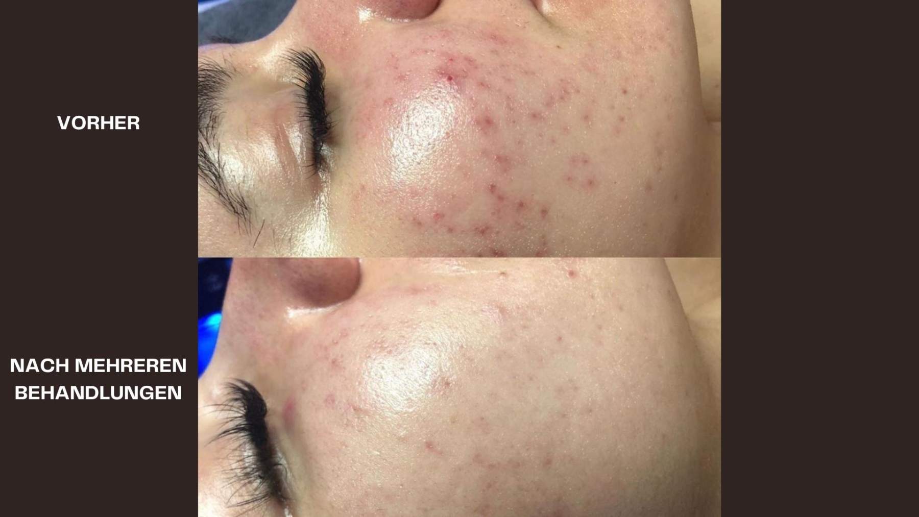 Hydrafacial Vorher - Nacher Bild Akne