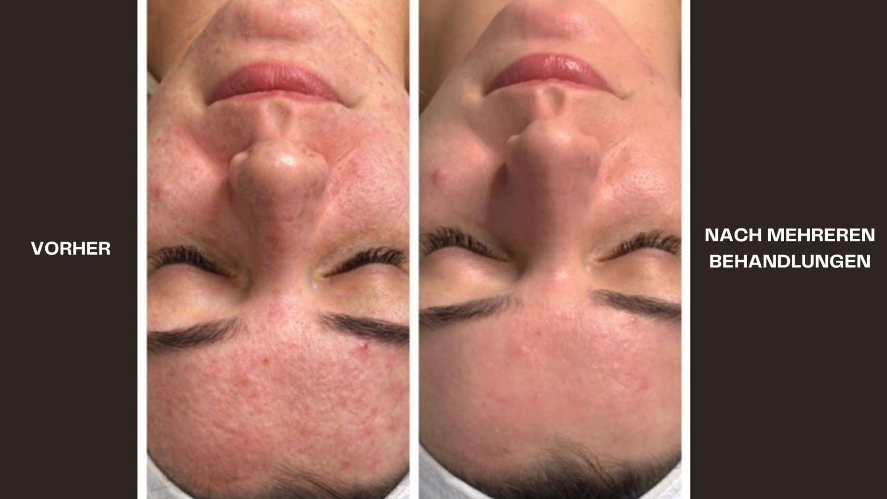 Hydrafacial Vorher - Nacher Bild Akne (2)-Nachher Fadenlifting - 7