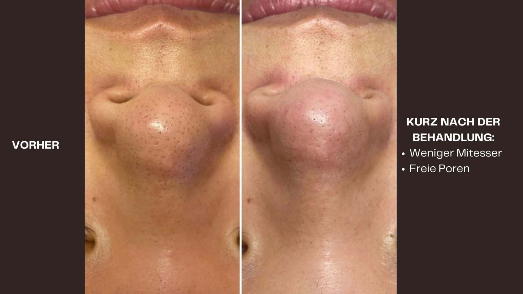 Hydrafacial Vorher - Nacher Bild Mitesser Nase
