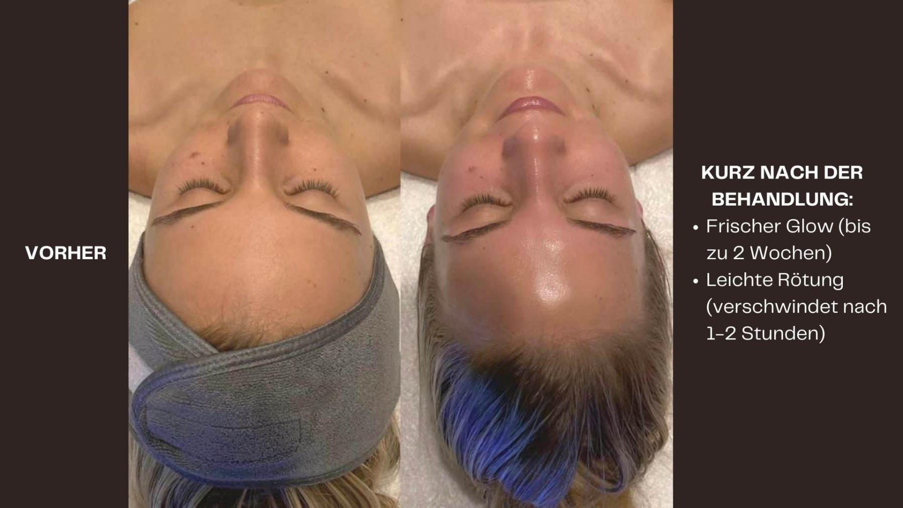 Hydrafacial Vorher - Nacher Bild