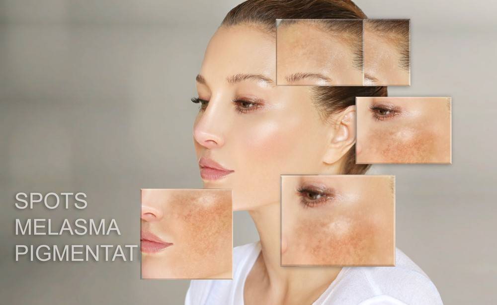 Pigmentflecken entfernen