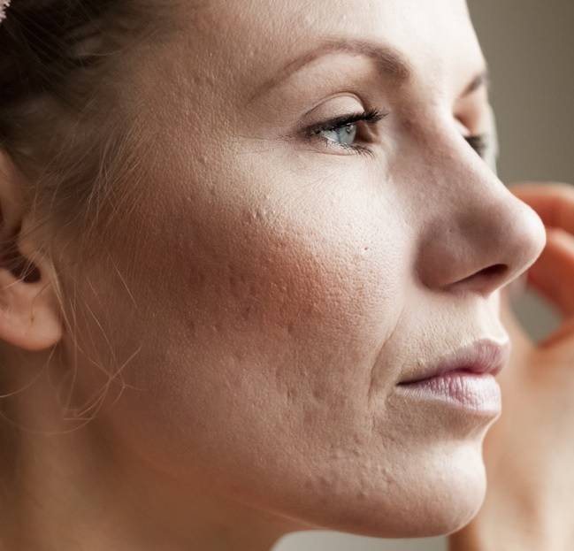 Aknenarben Gesicht Aknenarben