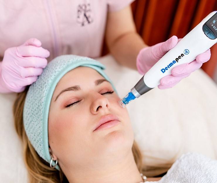 Microneedling Erfahrung