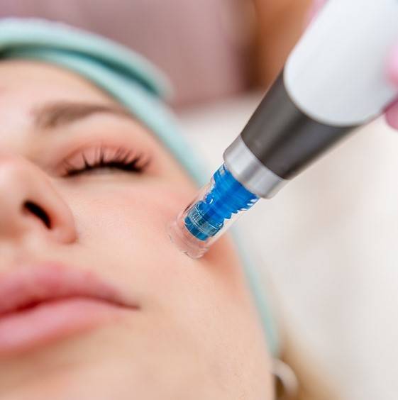 Microneedling bei GoAesthetic